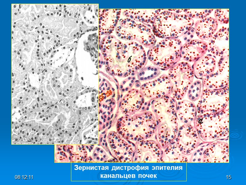 Зернистая дистрофия эпителия канальцев почек 08:12:01 15